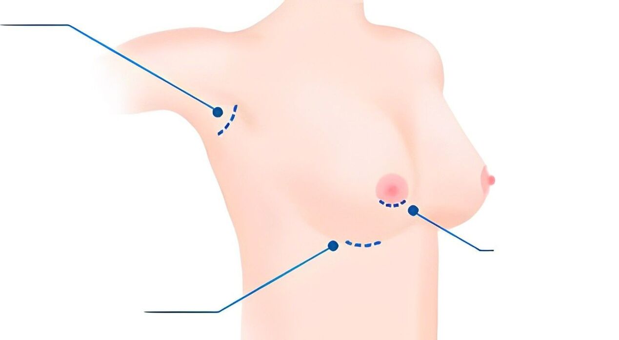 type of size for breast augmentation